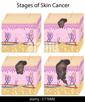 Cancro della pelle Foto Stock