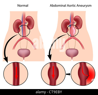 Aneurisma aortico addominale Foto Stock