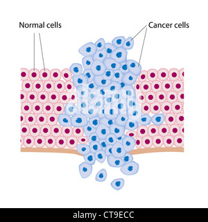 Le cellule del cancro in un tumore Foto Stock