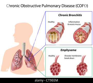 Malattia polmonare ostruttiva cronica Foto Stock