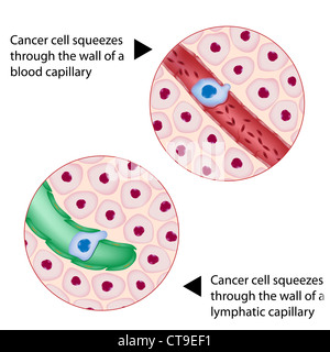 La cellula di cancro spreme attraverso il sangue e linfa nave Foto Stock