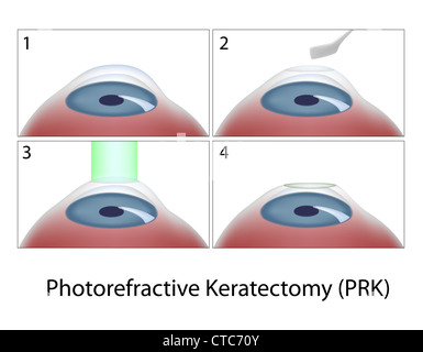 Cheratectomia fotorefrattiva (PRK) intervento chirurgico Foto Stock