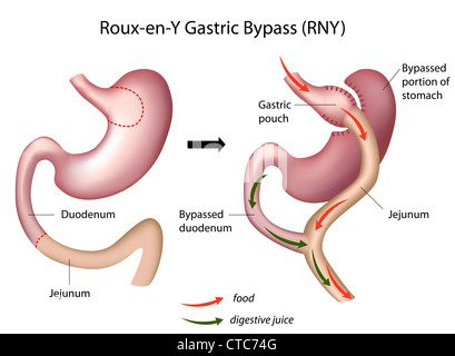 Roux-en-Y il by-pass gastrico (RNY chirurgia) Foto Stock