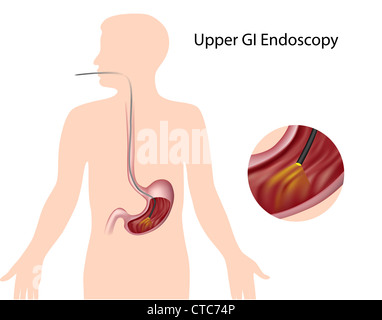 Endoscopia gastrointestinale superiore Foto Stock