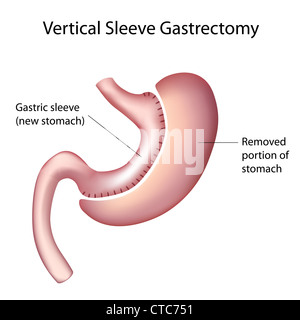 Manicotto verticale gastrectomia (VSG) Foto Stock