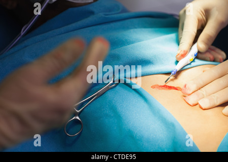 Medico usando un bisturi durante un intervento chirurgico Foto Stock