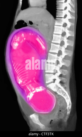 Scansione CT dell'addome di 25 anno vecchio donna incinta con pieno termine feto. Foto Stock