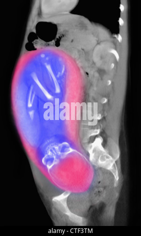 Scansione CT dell'addome di 25 anno vecchio donna incinta con pieno termine feto. Foto Stock