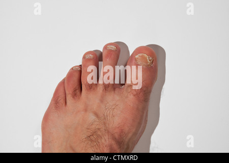 Onicomicosi toenail fungo malattia infezione su mans dita coursing sbriciolamento di distorsione. Foto Stock