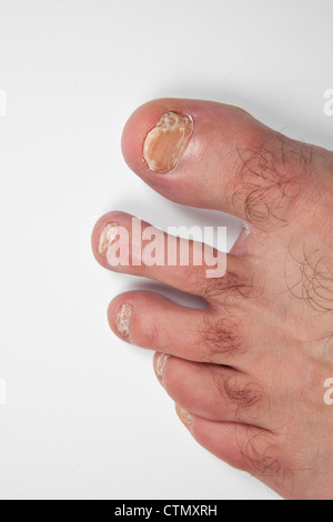 Onicomicosi toenail fungo malattia infezione su mans dita coursing sbriciolamento di distorsione. Foto Stock