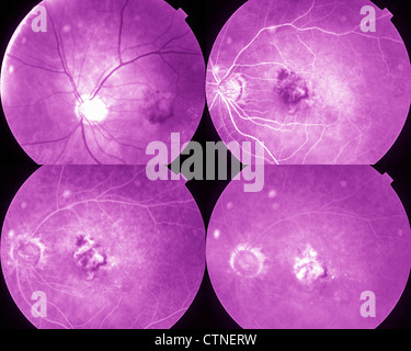 Quattro fasi angiografia oculare che mostra AMD degenerazione maculare senile Foto Stock