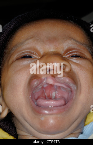 Schisi labiale e palatoschisi su un giovane nigeriano baby Foto Stock