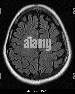 MRI che mostra la sclerosi multipla in un anno 42 vecchia donna Foto Stock