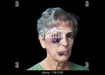 Una nonna duramente picchiati con cuciture, un occhio nero e un labbro di grasso. Foto Stock