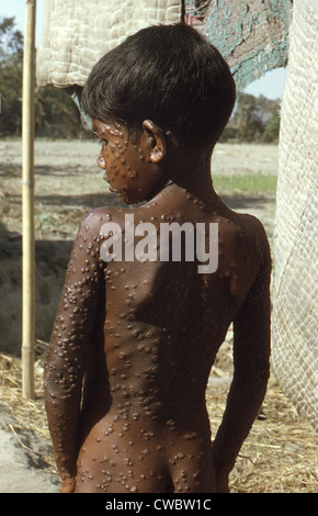 Giovani del Bangladesh con il virus del vaiolo nel 1974, ha la tipica eruzione cutanea che copre tutto il suo corpo con pustole. L'ultimo naturalmente Foto Stock