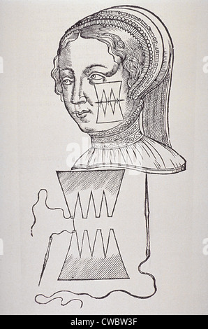 Illustrazione della tecnica di sutura che minimizzato cicatrizzazione di una ferita viso di una donna. Da Ambroise Pare, DIX LIVRES DE LA Foto Stock