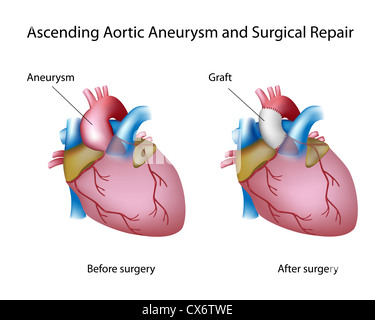 Ascendente aneurisma aortico e chirurgia aperta Foto Stock