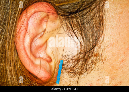 La terapia di agopuntura Foto Stock