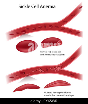 La malattia a cellule falciformi Foto Stock