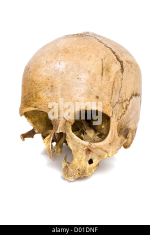 Un vecchio jawless Scull umano isolato su bianco Foto Stock