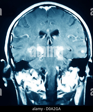 Il Morbo di Parkinson, MRI Foto Stock