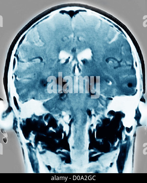 Il Morbo di Parkinson, MRI Foto Stock