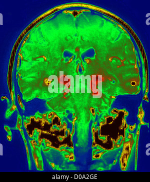 Il Morbo di Parkinson, MRI Foto Stock