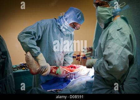 Protesi del ginocchio, chirurgia Foto Stock