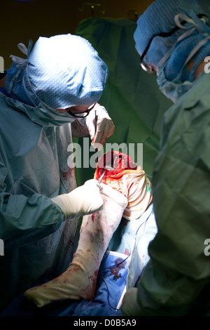 Protesi del ginocchio, chirurgia Foto Stock