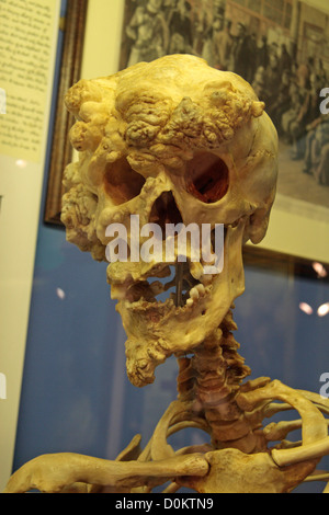 Replica dello scheletro di Joseph Merrick, l'Elephant Man, il Royal Hospital di Londra museo, Whitechapel di Londra, Regno Unito. Foto Stock