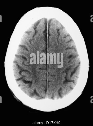 Scansione TC di uomo anziano con il vecchio infarto occipitale Foto Stock