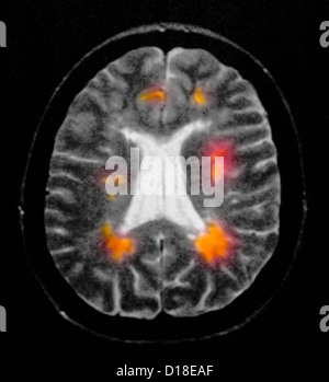 Risonanza magnetica cerebrale che mostra la sclerosi multipla Foto Stock