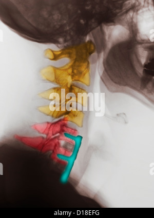 Xray cervicale che mostra la fusione spinale, C5, C6, C7 Foto Stock