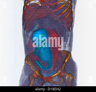 3D CT scan, pieno termine di feto in posizione podalica Foto Stock