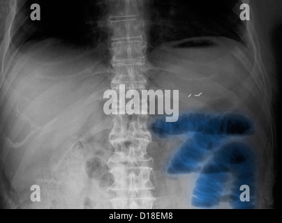 Addominali X-ray, piccola ostruzione intestinale Foto Stock