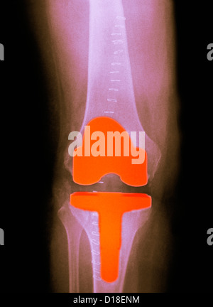 Sostituzione del ginocchio in 61 anni, femmina Foto Stock