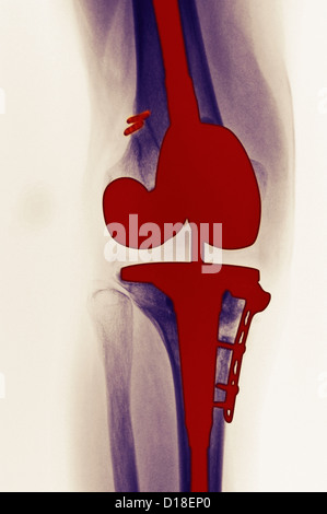 X-ray, la sostituzione totale del ginocchio Foto Stock