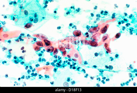 Micrografia di Luce che mostra il cancro cervicale Foto Stock