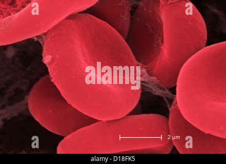 Micrografia elettronica di cellule rosse del sangue e fibrina Foto Stock