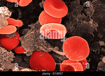 Micrografia elettronica di cellule rosse del sangue e fibrina Foto Stock