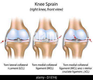Distorsione del ginocchio Foto Stock