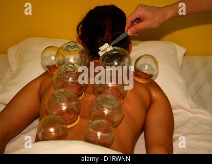 Coppettazione cinese della medicina Foto Stock