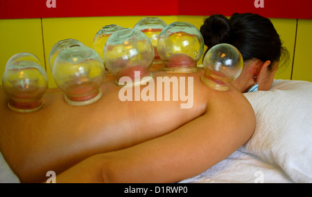 Coppettazione cinese della medicina Foto Stock