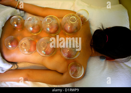 Coppettazione cinese della medicina Foto Stock