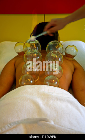 Coppettazione cinese della medicina Foto Stock