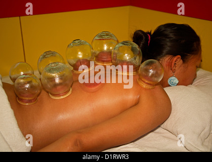 Coppettazione cinese della medicina Foto Stock
