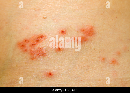 Lieve caso di herpes zoster rash sul lato del corpo. Foto Stock