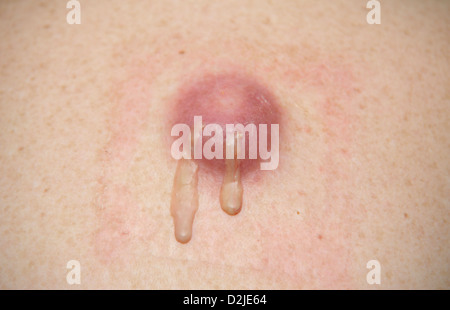 Cisti infette pianto Foto Stock