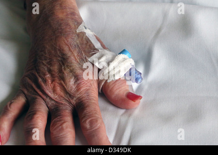 Cannula nel pollice della donna anziana con mano molto livida e nocche mostrano osteoartrite in Hospital Inghilterra Foto Stock