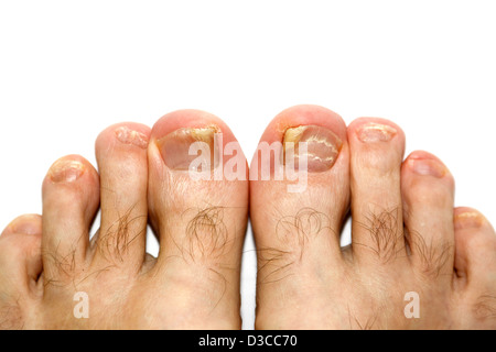 Dermatophytic onicomicosi infezione fungina in Le Mans toenails Foto Stock